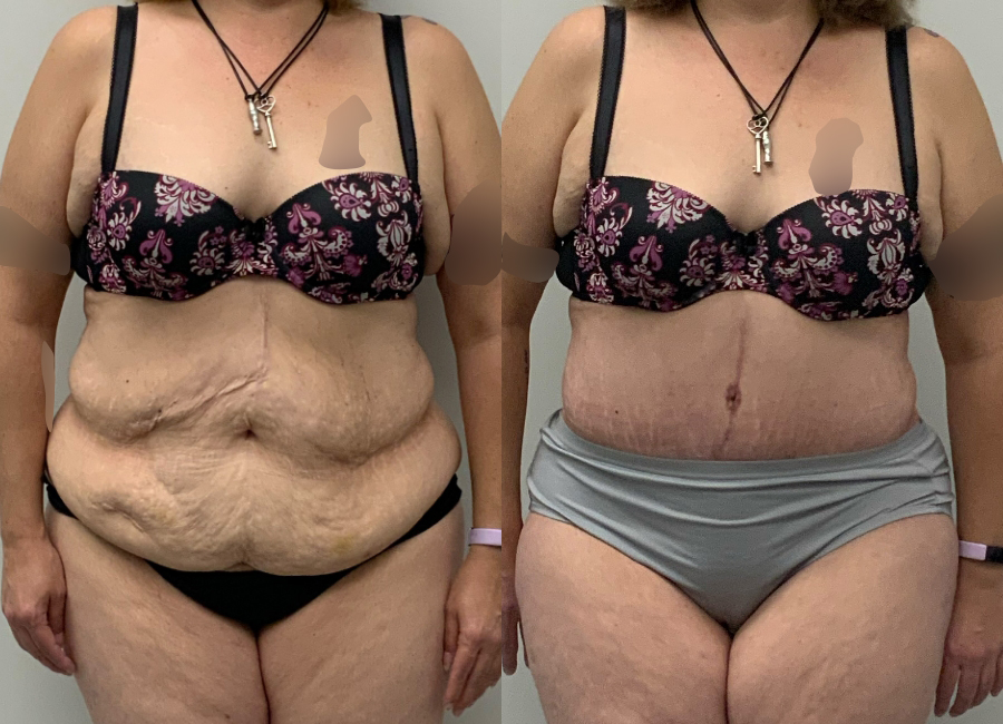 This is one of our beautiful post-bariatric body contouring patient 50