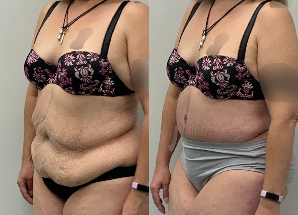 This is one of our beautiful post-bariatric body contouring patient #50