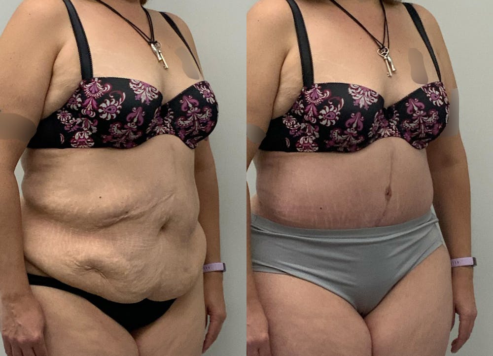 This is one of our beautiful post-bariatric body contouring patient #50