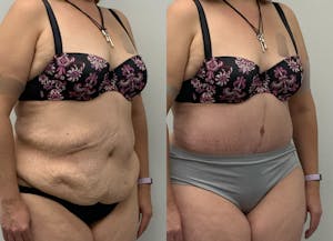 This is one of our beautiful post-bariatric body contouring patient 50