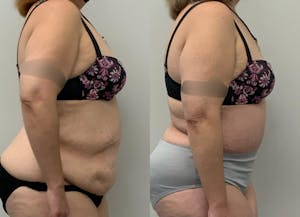 This is one of our beautiful post-bariatric body contouring patient 50