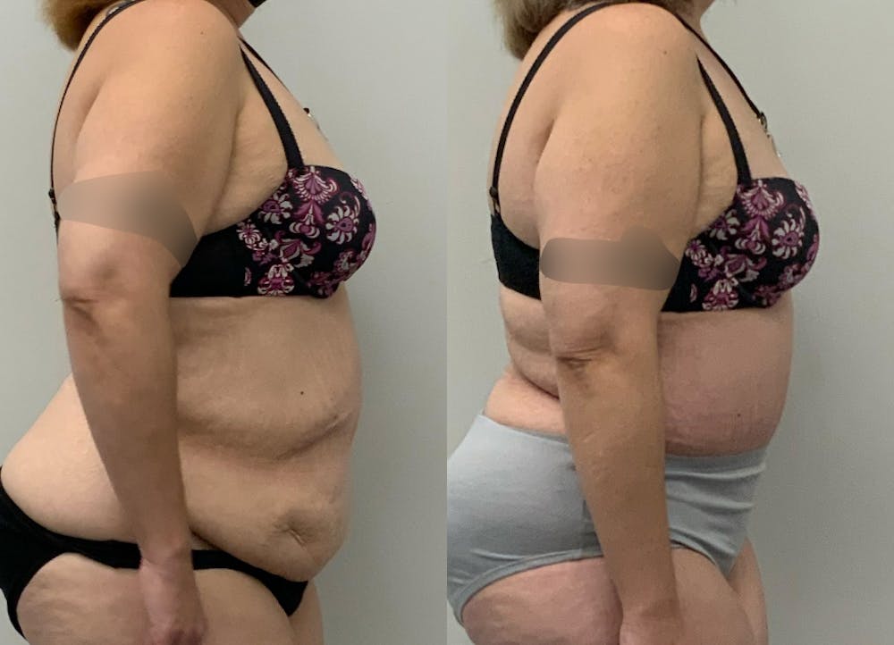 This is one of our beautiful post-bariatric body contouring patient #50