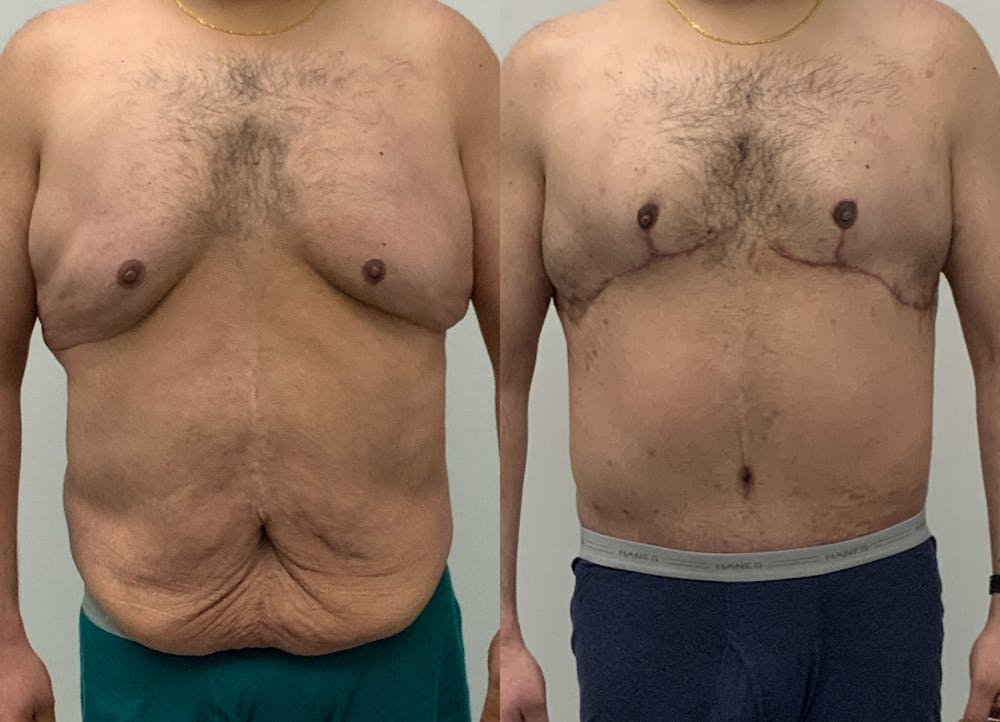 This is one of our beautiful tummy tuck patient #87
