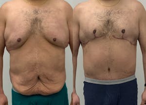 This is one of our beautiful tummy tuck patient 87