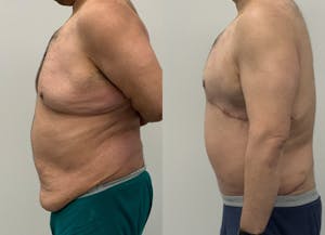 This is one of our beautiful tummy tuck patient 87