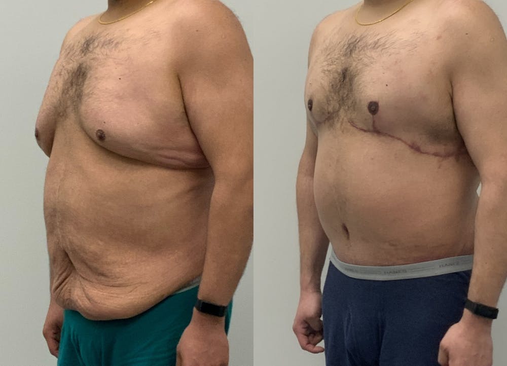 This is one of our beautiful tummy tuck patient #87
