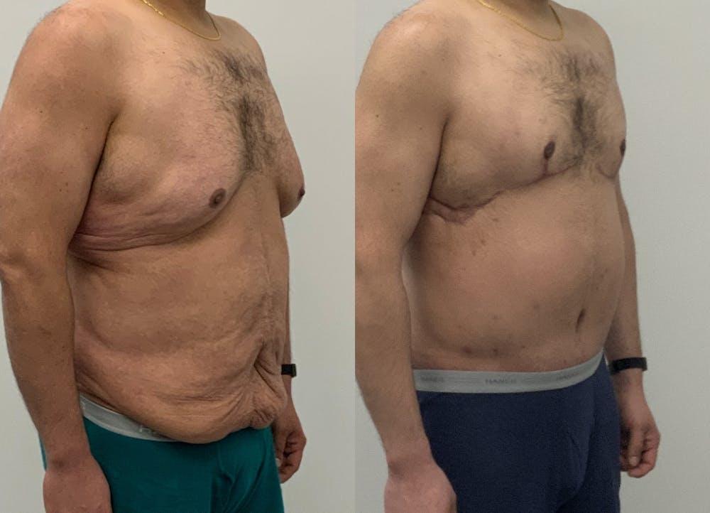 This is one of our beautiful tummy tuck patient #87