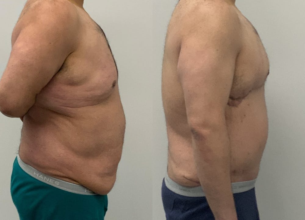 This is one of our beautiful tummy tuck patient #87