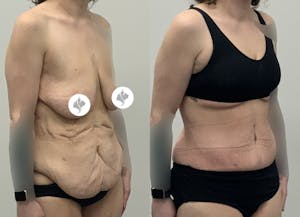 This is one of our beautiful post-bariatric body contouring patient 51
