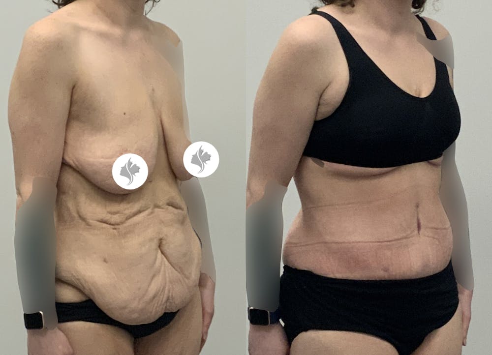 This is one of our beautiful post-bariatric body contouring patient #51