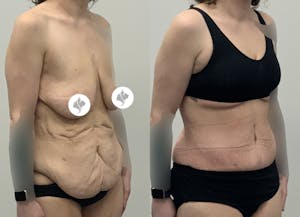 This is one of our beautiful tummy tuck patient 88