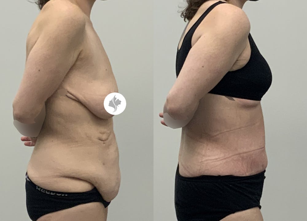 This is one of our beautiful post-bariatric body contouring patient #51