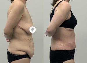 This is one of our beautiful post-bariatric body contouring patient 51
