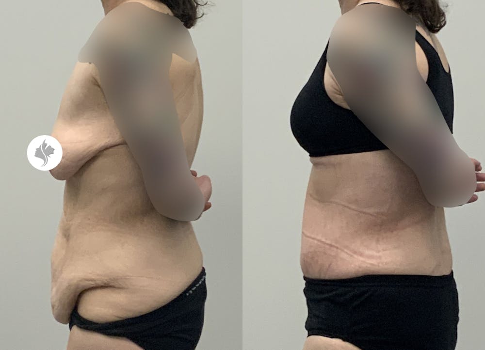 This is one of our beautiful post-bariatric body contouring patient #51