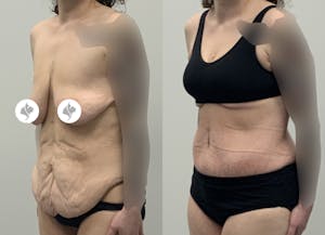 This is one of our beautiful post-bariatric body contouring patient 51