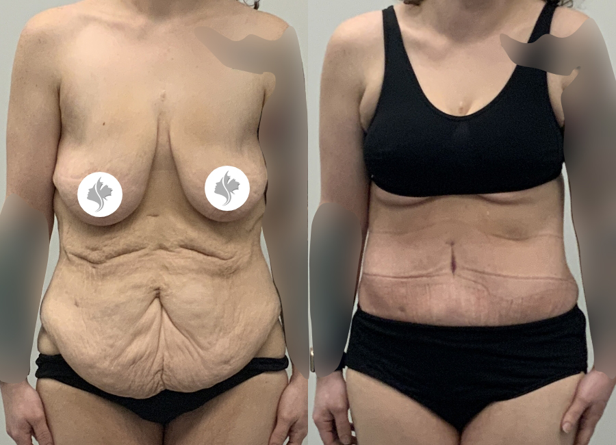 This is one of our beautiful post-bariatric body contouring patient 51