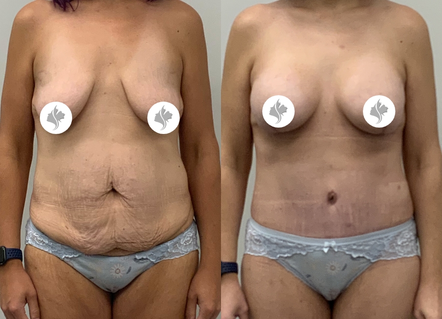 This is one of our beautiful tummy tuck patient 92