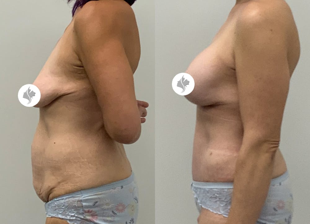 This is one of our beautiful tummy tuck patient #90