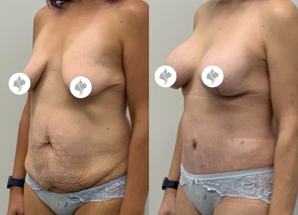 This is one of our beautiful tummy tuck patient #90