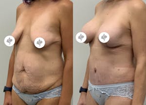 This is one of our beautiful tummy tuck patient 90