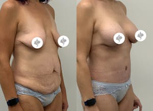 This is one of our beautiful tummy tuck patient 90
