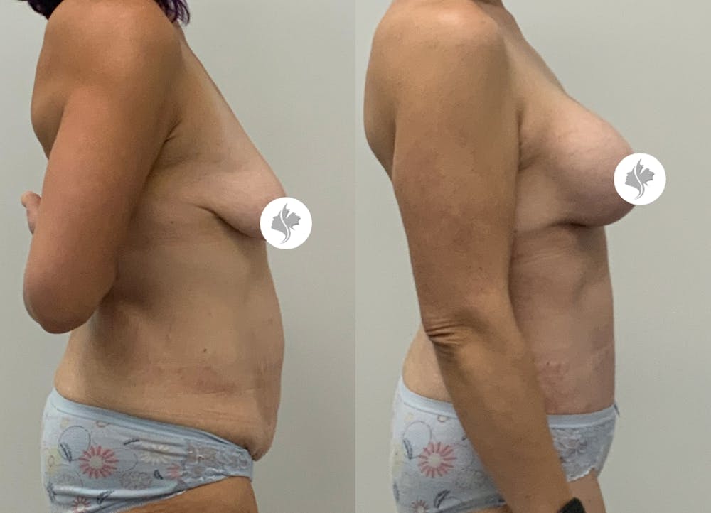 This is one of our beautiful tummy tuck patient #90