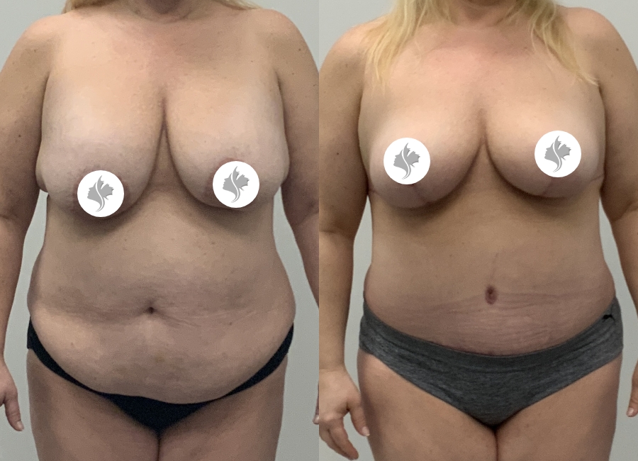 This is one of our beautiful tummy tuck patient 91