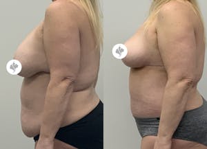 This is one of our beautiful mommy makeover patient 4