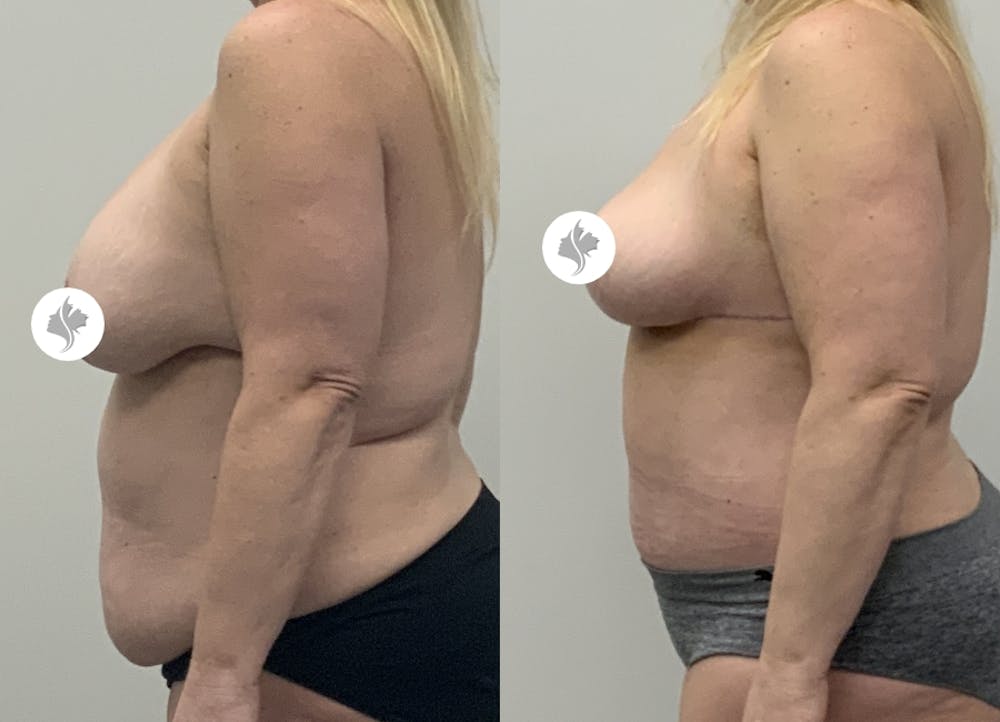 This is one of our beautiful tummy tuck patient #93