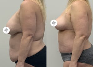 This is one of our beautiful tummy tuck patient 91