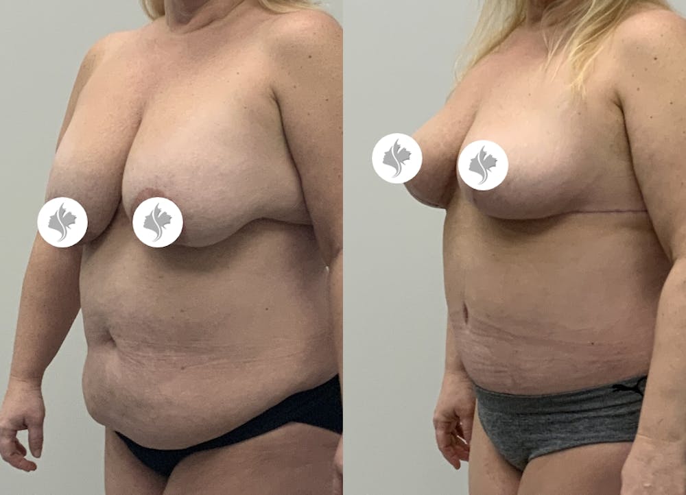 This is one of our beautiful tummy tuck patient #93