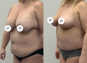 This is one of our beautiful mommy makeover patient 4