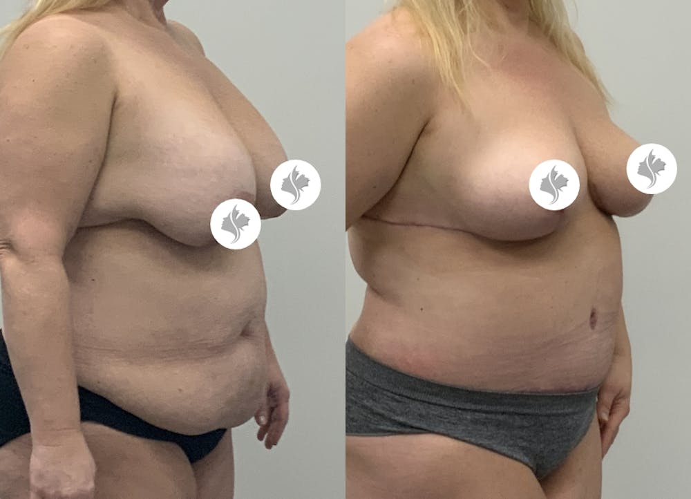 This is one of our beautiful tummy tuck patient #93