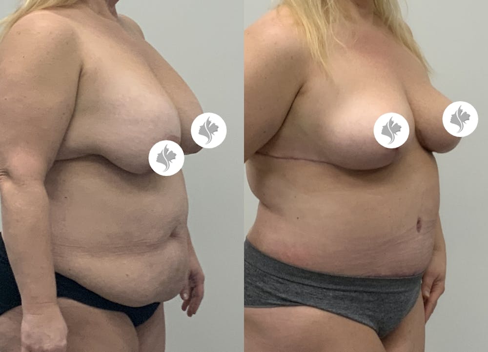This is one of our beautiful tummy tuck patient #91