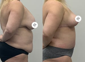 This is one of our beautiful mommy makeover patient 4