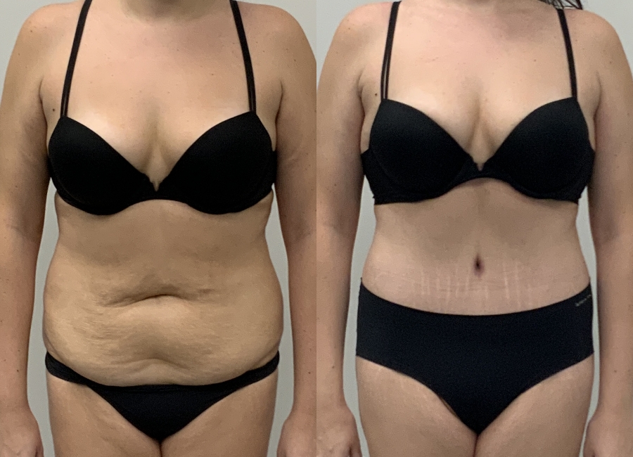 This is one of our beautiful tummy tuck patient 94