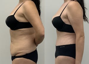This is one of our beautiful mommy makeover patient 3