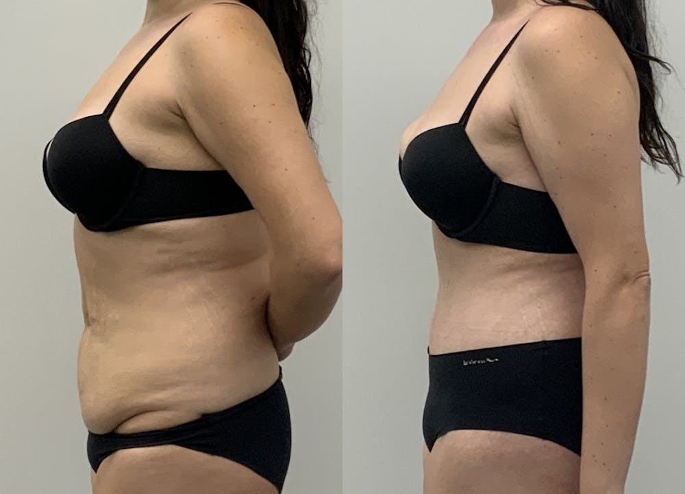 This is one of our beautiful tummy tuck patient #92