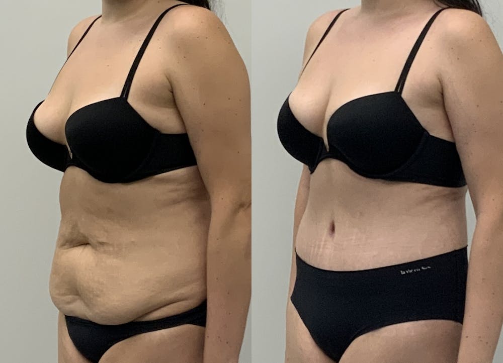 This is one of our beautiful tummy tuck patient #94