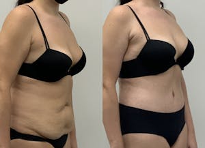 This is one of our beautiful mommy makeover patient 3