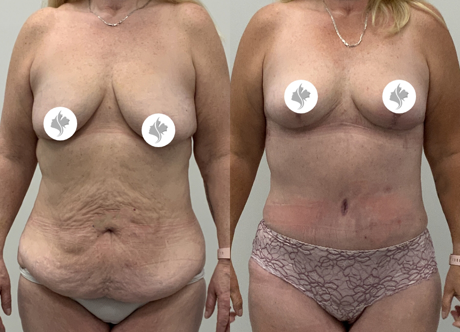 This is one of our beautiful post-bariatric body contouring patient 52