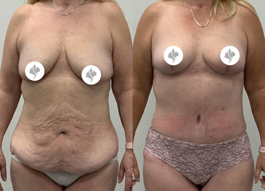 This is one of our beautiful tummy tuck patient 95