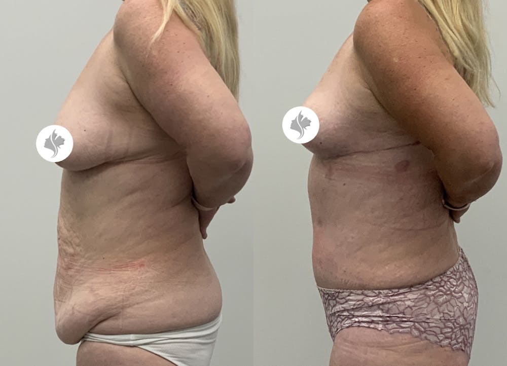 This is one of our beautiful post-bariatric body contouring patient #52