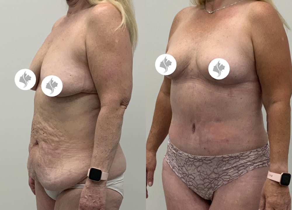 This is one of our beautiful post-bariatric body contouring patient #52