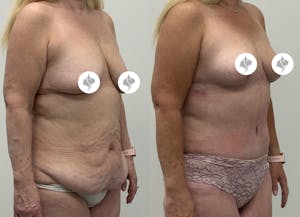 This is one of our beautiful tummy tuck patient 93