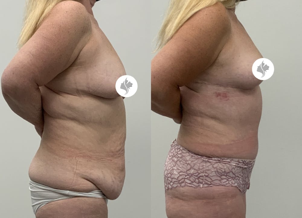 This is one of our beautiful tummy tuck patient #95