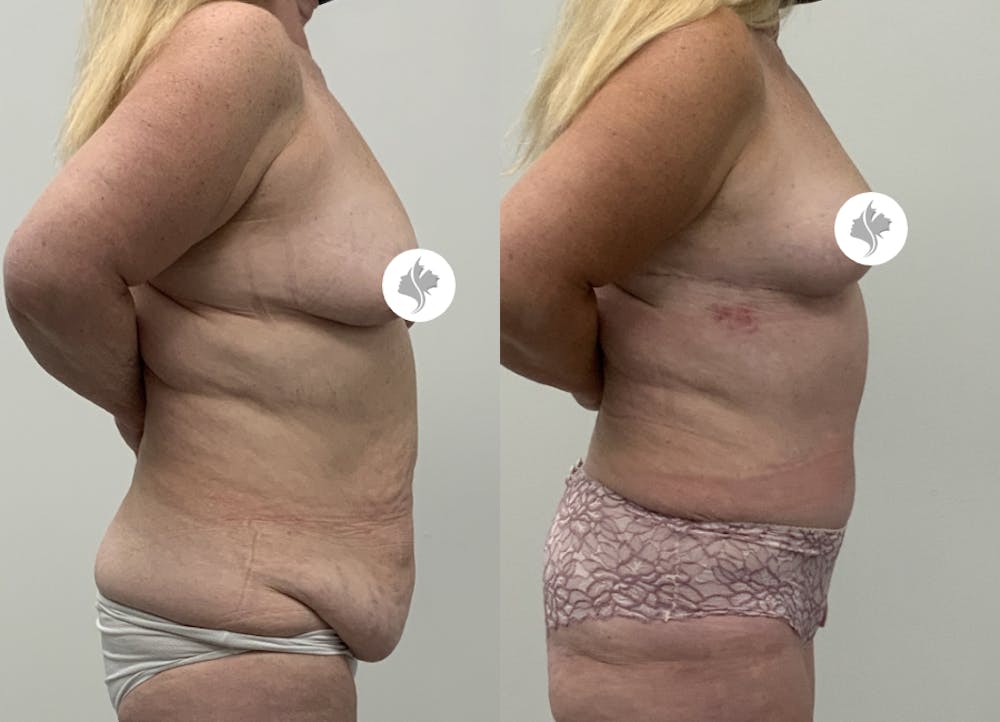 This is one of our beautiful tummy tuck patient #93