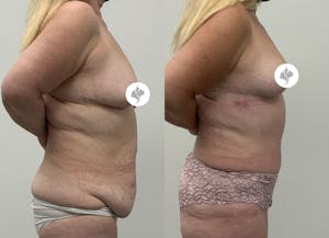 This is one of our beautiful post-bariatric body contouring patient 52