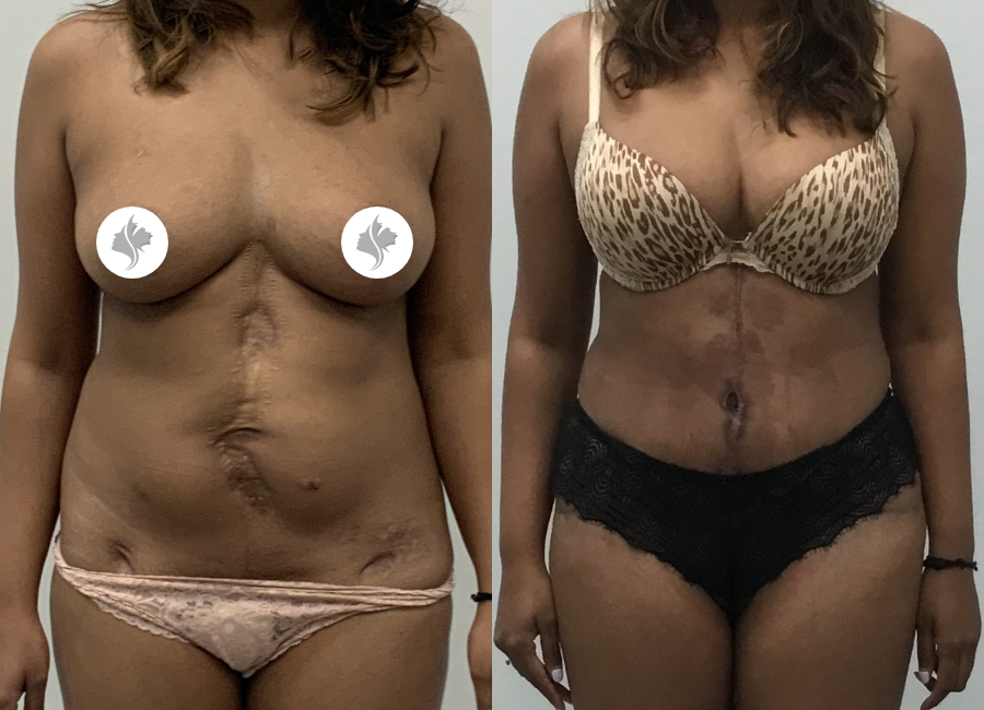 This is one of our beautiful tummy tuck patient 94