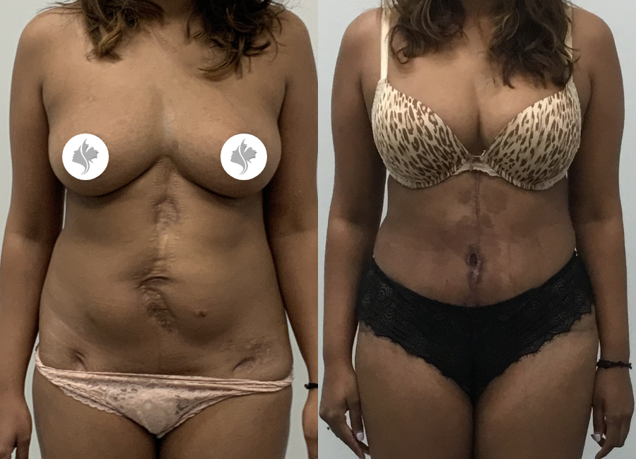 This is one of our beautiful tummy tuck patient 35